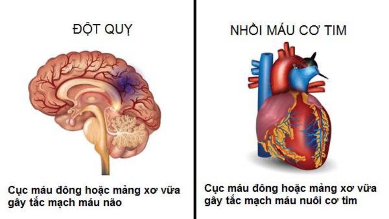 Phân biệt dấu hiệu trước khi bị nhồi máu cơ tim và đột quỵ