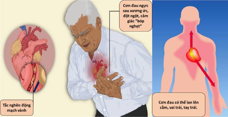 Dấu hiệu nhận biết cơn nhồi máu cơ tim tái phát