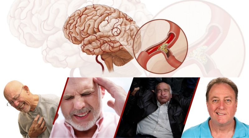 Đột quỵ và tai biến có giống nhau không? 9 điều cần biết