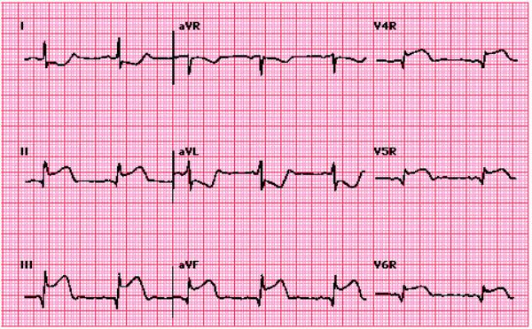 Hình ảnh dấu hiệu nhồi máu cơ tim cấp