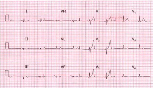 Hình ảnh điện tâm đồ nhồi máu cơ tim cũ