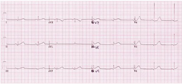 Hình ảnh điện tâm đồ nhồi máu cơ tim sau
