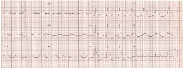 Hình ảnh điện tâm đồ nhồi máu cơ tim thành trước