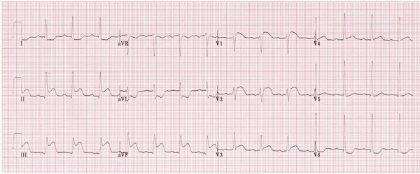 Hình ảnh điện tâm đồ nhồi máu cơ tim thất phải