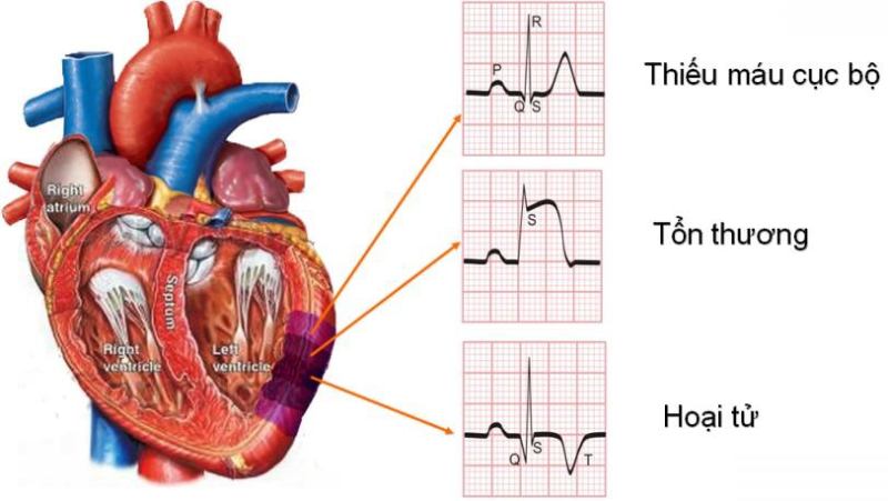 Vai trò điện tâm đồ trong phát hiện nhồi máu cơ tim