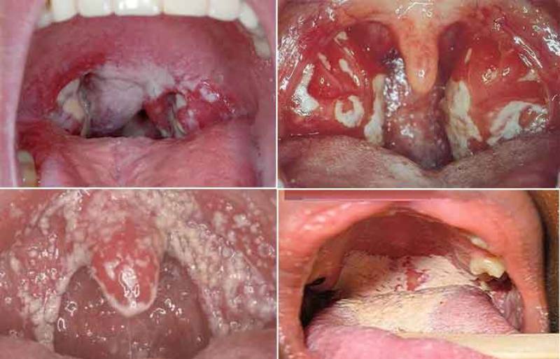 Hình ảnh về tình trạng bệnh lậu ở miệng khi bị nhiễm lậu cầu khuẩn