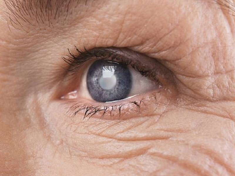 Phân loại bệnh đục thủy tinh thể ở mắt