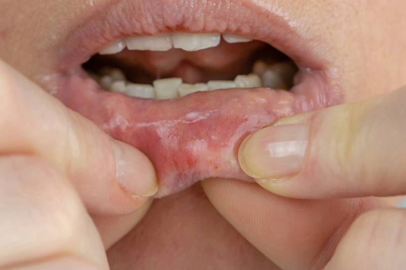 Hướng dẫn điều trị bệnh lậu ở miệng đúng cách bằng thuốc