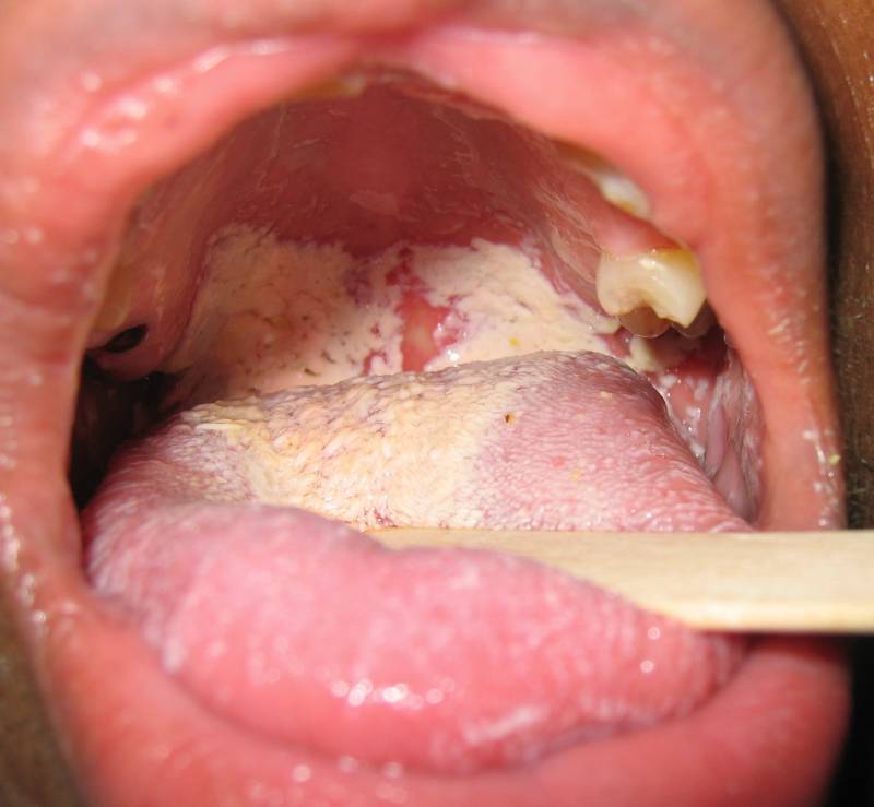 Nguy hiểm của bệnh lậu ở miệng khi bị biến chứng nặng