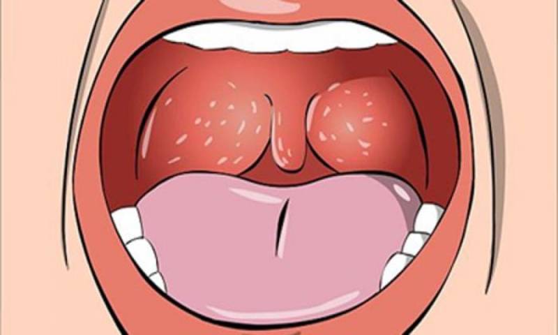 Hình ảnh minh họa bệnh lậu ở miệng và họng bị lây nhiễm khi quan hệ tình dục