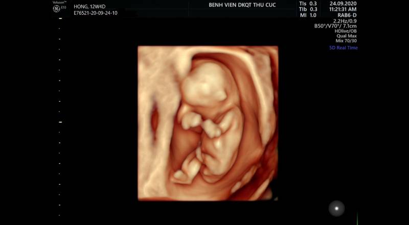 Hình ảnh thai nhi 12 tuần thu được từ siêu âm 4 chiều, đây là mốc thời gian quan trọng được bác sĩ khuyến cáo