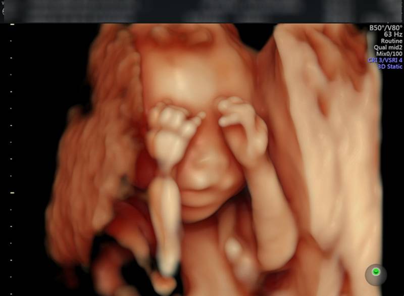 Hình ảnh siêu âm 4 chiều thai 20 tuần, thai di đang phát thiện gần như hoàn thiện các bộ phận trên cơ thể