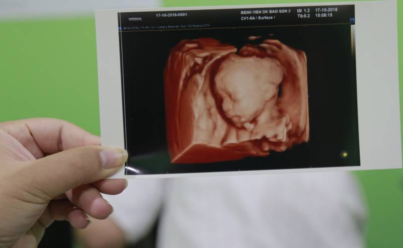 Kết quả hình ảnh siêu âm 4 chiều thai 23 tuần giúp bác sĩ chuẩn đoán và tầm soát các dị tật bẩm sinh