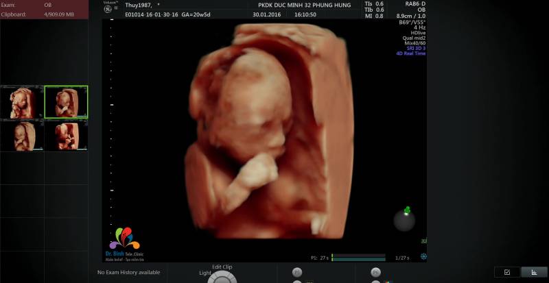Hình ảnh siêu âm 4D thai nhi 22 tuần có thể quan sát rõ nét các chuyển động của bé