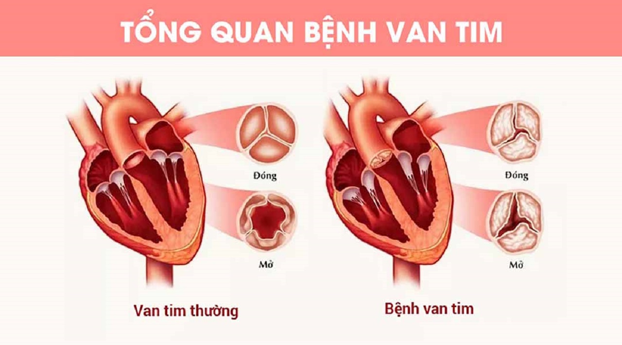 benh-van-tim