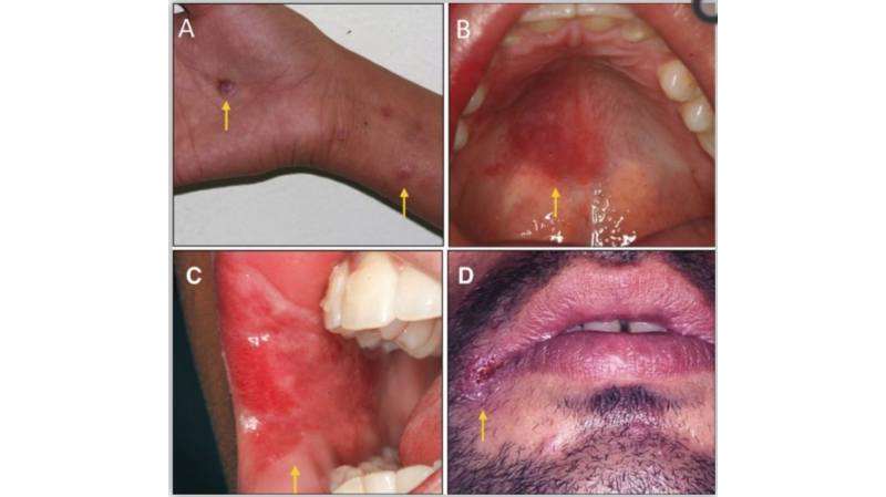 Bệnh giang mai ở miệng: nguyên nhân, triệu chứng, cách chữa