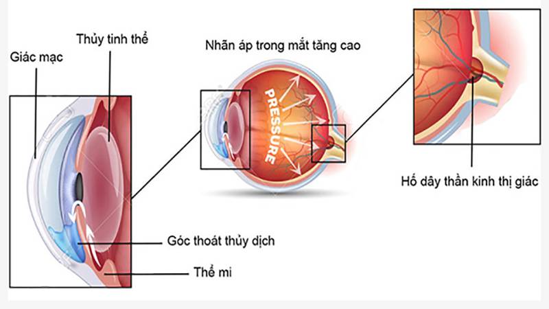 Cấu tạo của mắt và nguyên nhân gây hội trứng Glocom góc mở
