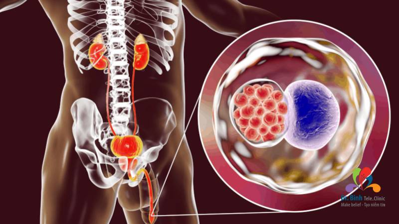 Cách phòng tránh bệnh lây nhiễm qua đường tình dục Chlamydia hiệu quả