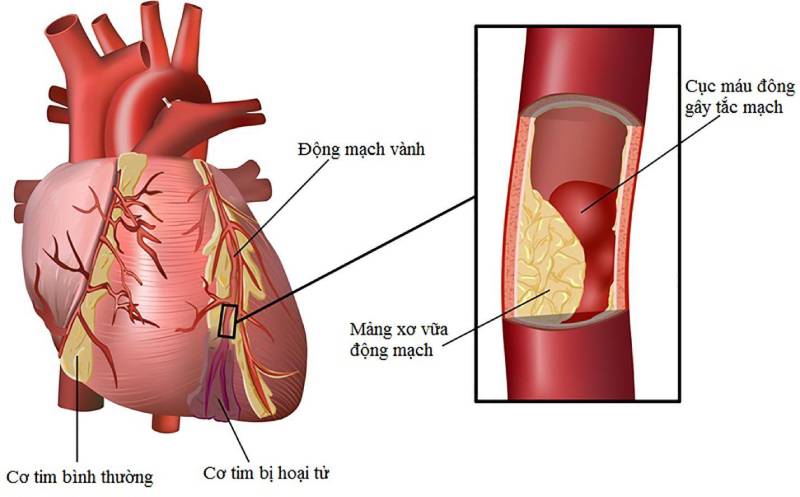 Nguyên nhân dẫn tới các cơn đau tim cấp cực nguy hiểm