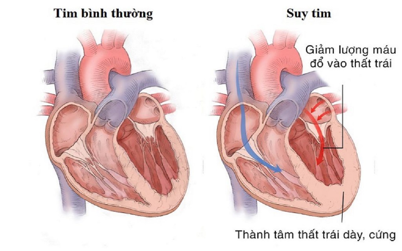 BỆNH TIM - NHỮNG ĐIỀU CẦN BIẾT ĐỂ CÓ MỘT TRÁI TIM KHỎE MẠNH