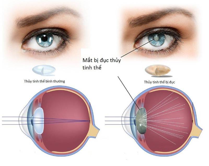 Tìm hiểu về bệnh đục thủy tinh thể hay cườm khô, cườm đá ở mắt