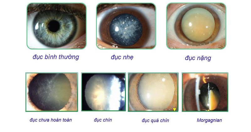 Hình ảnh minh họa mắt bị đục thủy tinh thể ở các giai đoạn