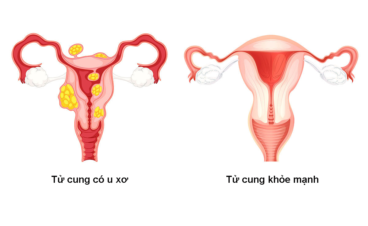 u-xo-tu-cung-nguy-hiem-the-nao