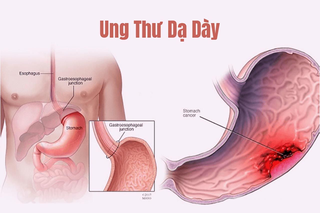 tai-sao-cang-ngay-cang-co-nhieu-nguoi-mac-ung-thu-da-day