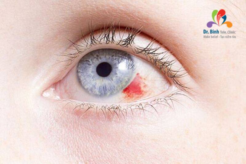 Hình ảnh mắt bị xuất huyết tiền phòng tuyến gây biến chứng tăng nhãn áp
