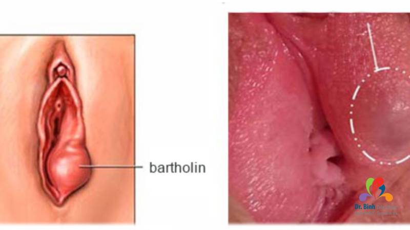 Tình trạng viêm âm đạo do lây truyền qua đường tình dục, một trong các bệnh std nguy hiểm