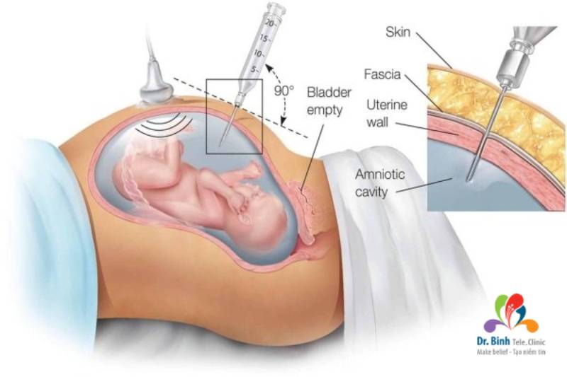 Phương pháp xét nghiệm chọc do nước ối giúp phát hiện thai nhi bị hội chứng Down bẩm sinh