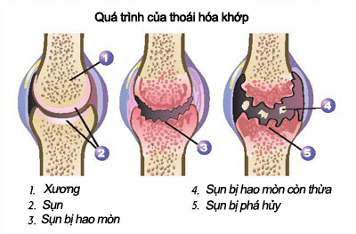 bệnh đau khớp gối