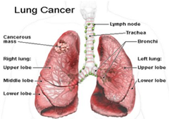 Cần biết về bệnh Ung thư phổi