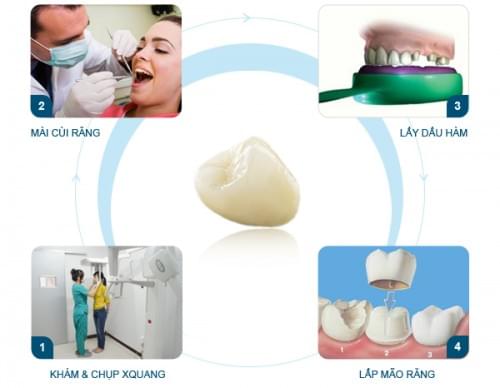 Bọc răng sứ có đau không