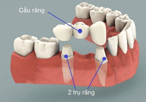 cầu răng