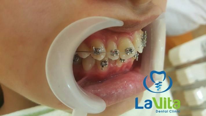Chăm sóc răng miệng trong thời gian chỉnh nha