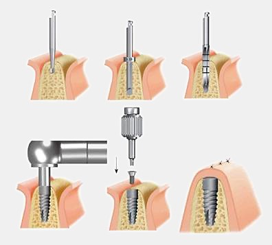 cấy ghép Implant