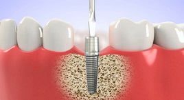 Cấy ghép Implant ở độ tuổi nào là thích hợp Cấy ghép Implant ở độ tuổi nào là thích hợp