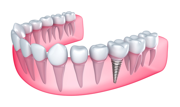 Cấy ghép Implant ở độ tuổi nào là thích hợp Độ tuổi nào có thể cấy ghép Implant