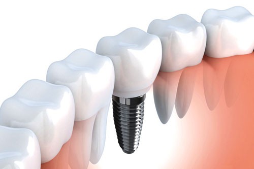 Cấy ghép Implant ở độ tuổi nào là thích hợp Độ tuổi nào có thể cấy ghép Implant