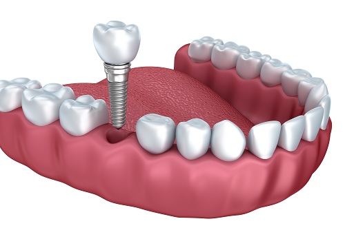 Cấy ghép Implant ở độ tuổi nào là thích hợp Cấy ghép Implant ở độ tuổi nào là thích hợp