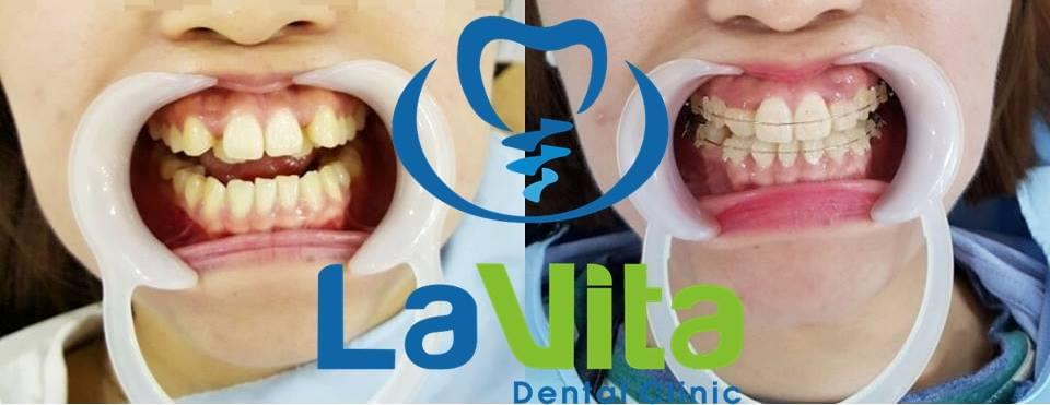 Những điều cần biết về chỉnh hình RHM