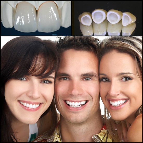 Răng sứ không kim loại Cercon Răng sứ không kim loại Cercon