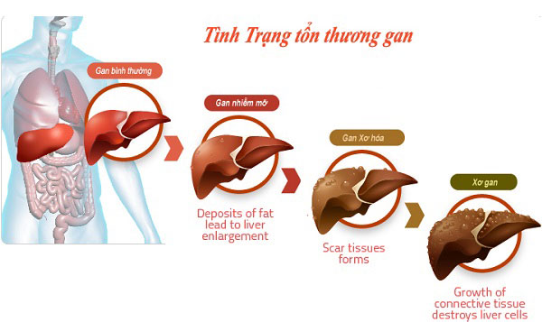 Chế độ ăn nào đảm bảo dinh dưỡng cho người bệnh viêm gan?