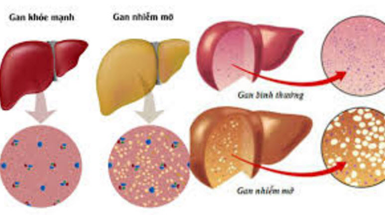 Để chữa bệnh gan nhiễm mỡ hiệu quả thì bạn phải làm gì ?