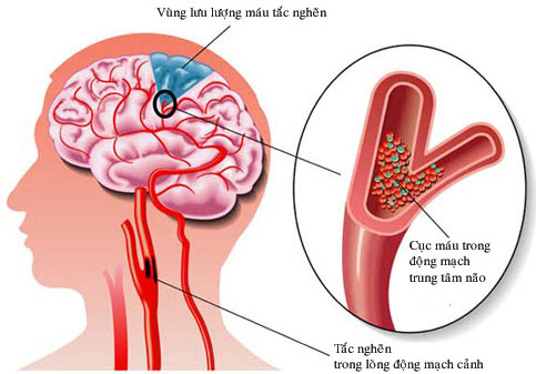 Hình ảnh Bệnh thiểu năng tuần hoàn não là gì? Nguyên nhân và triệu trứng