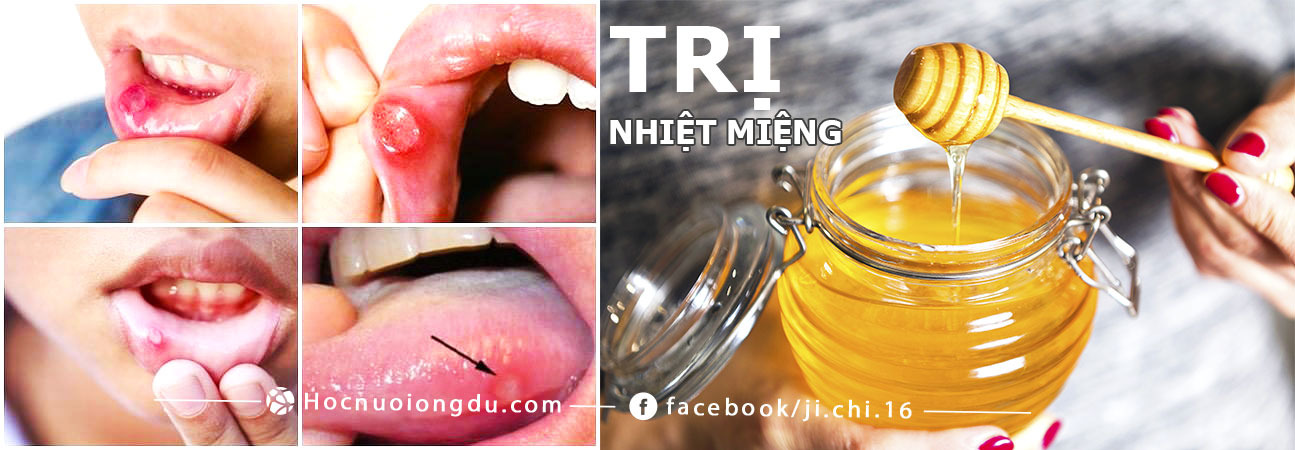 mật ong hiệu quả trong điều trị chứng nhiệt miệng