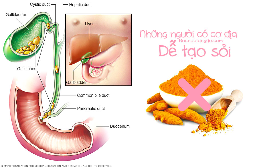 tác hại của tinh bột nghệ dễ tạo sỏi trong cơ thể