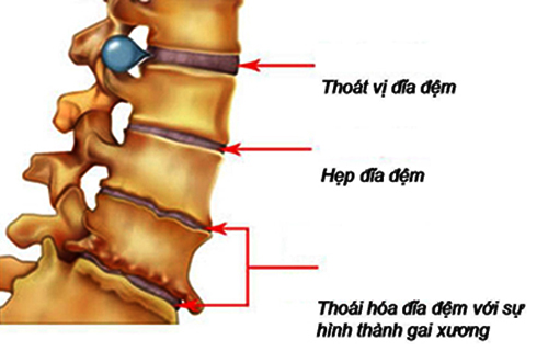 Bệnh gai cột sống