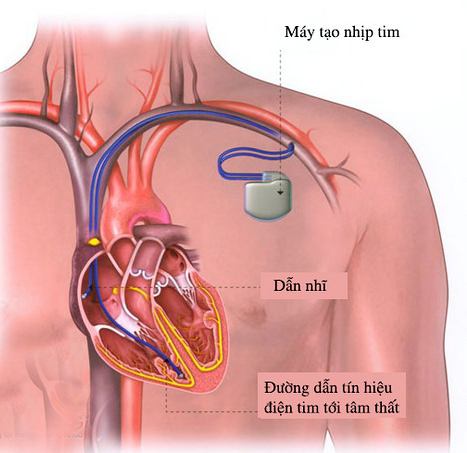 Dấu hiệu nghiêm trọng của bệnh tim mạch bạn không nên bỏ qua